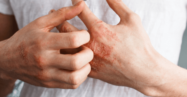 Penyakit Psoriasis Gejala Penyebab Pengobatan Dan Komplikasinya